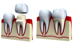 Коли забудування коронки на зуб може викликати проблеми?